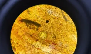 Ngứa cả năm mới phát hiện mắc sán dây chuột